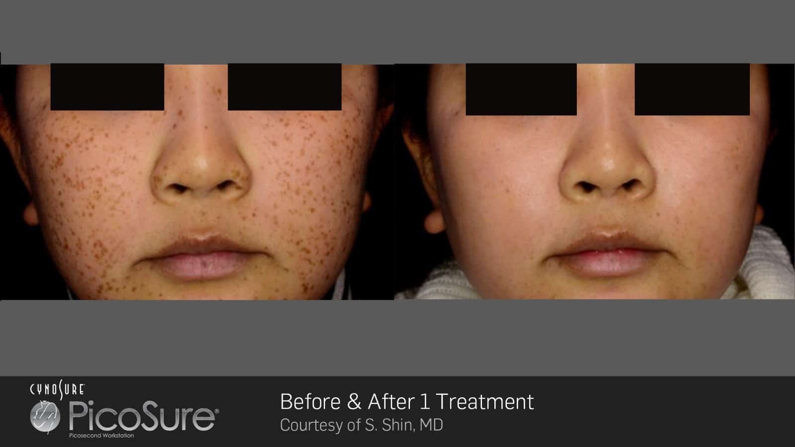 before and after image of a patient that has undergone a picosure treatment at Zahra medical spa in kelowna