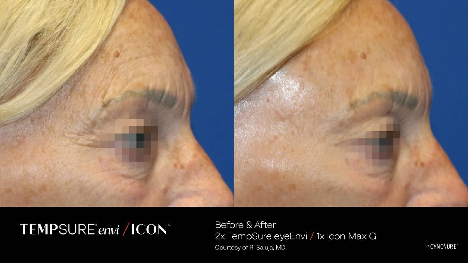 older woman before and after a tempsure medical spa procedure